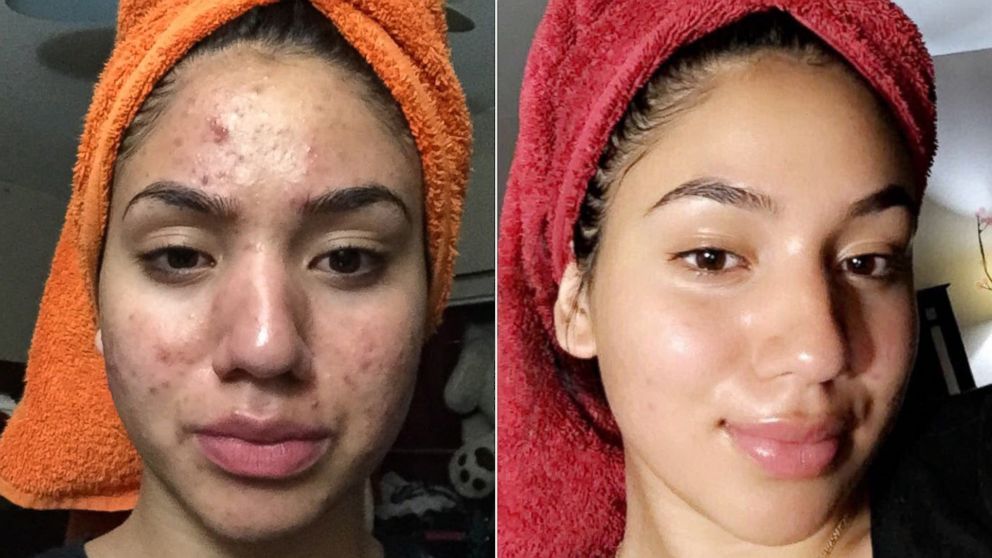 How to prevent & treat breakouts and spots